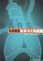 SARS�ٴ���X��ͼ��
